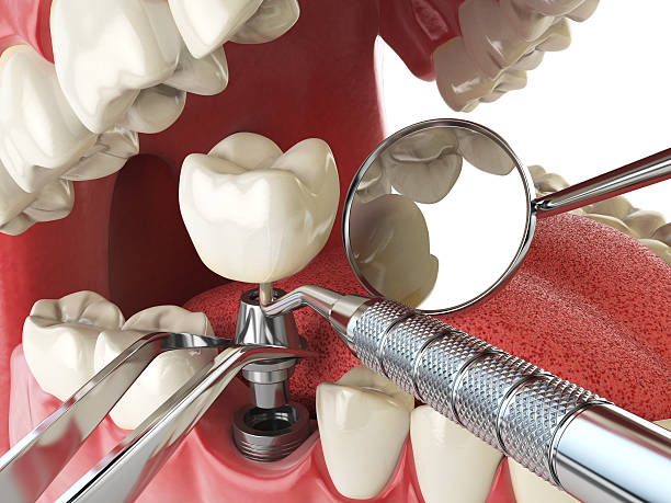 Best Emergency Treatment for Dental Infections or Abscesses in Sleepy Eye, MN